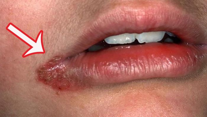 常见的是乾燥舔嘴唇,以致嘴角积聚唾液,助长真菌生长和繁殖且导致感染
