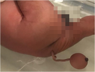 男嬰的尾巴。圖片來源：兒科手術病例報告期刊
