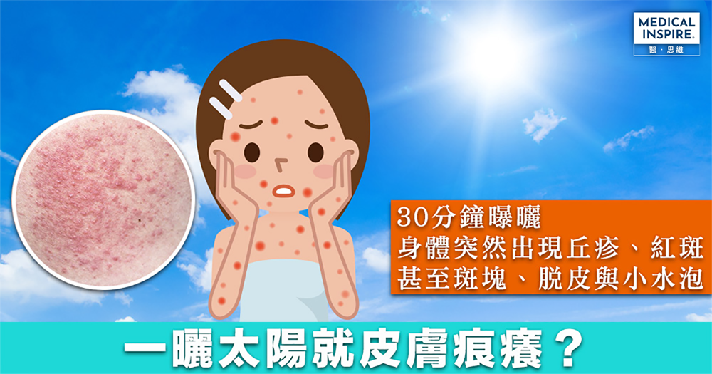 【常見皮膚病】小心猛烈陽光引起敏感,形成「多形性日光疹」。 – Medical Inspire 醫・思維