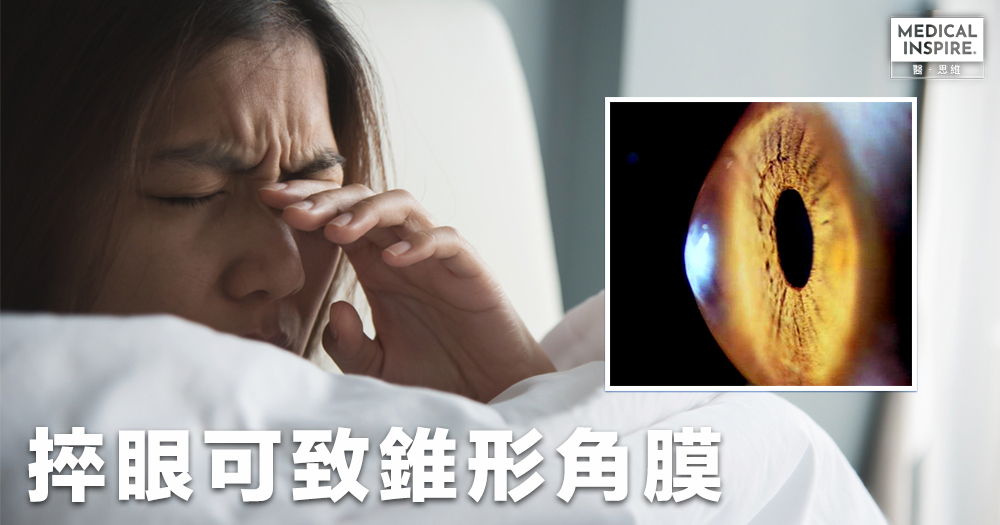 【不良習慣】了解眼睛痕癢的原因,胡亂捽眼可致眼角膜變形。 – Medical Inspire 醫・思維