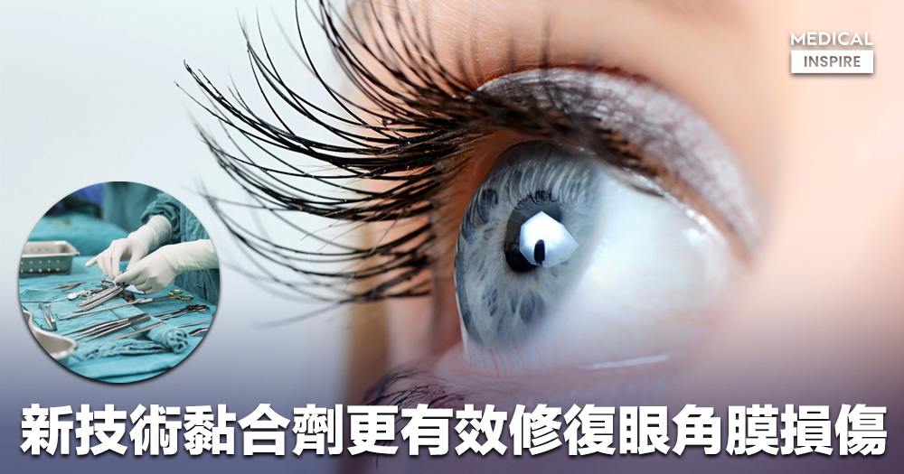 醫療科技】現時治療眼角膜損傷方法仍有缺陷；研究發明新黏合劑更有效 