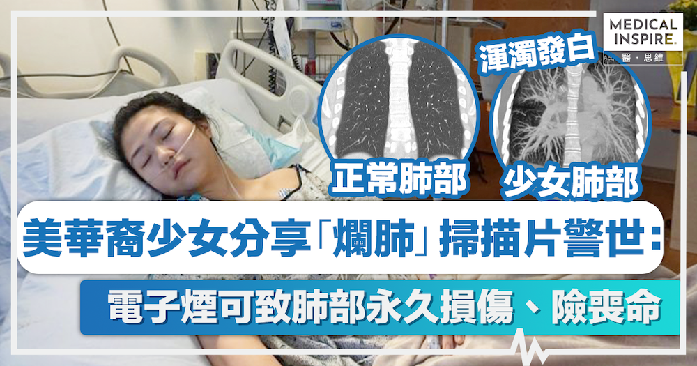 電子煙|美華裔少女分享「爛肺」掃描片警世:電子煙可致肺部永久損傷、險喪命 電子煙|美華裔少女分享「爛肺」掃描片警世:電子煙可致肺部永久損傷、險喪命