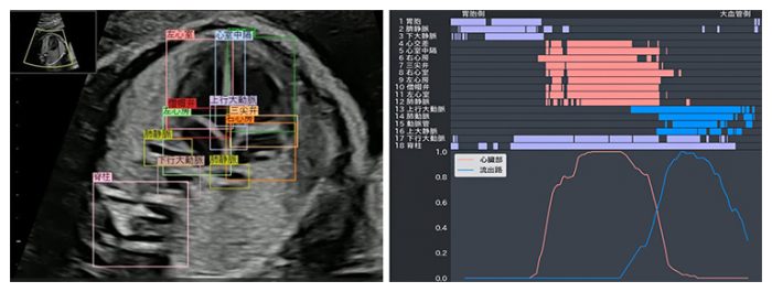 AI檢查胎兒心臟